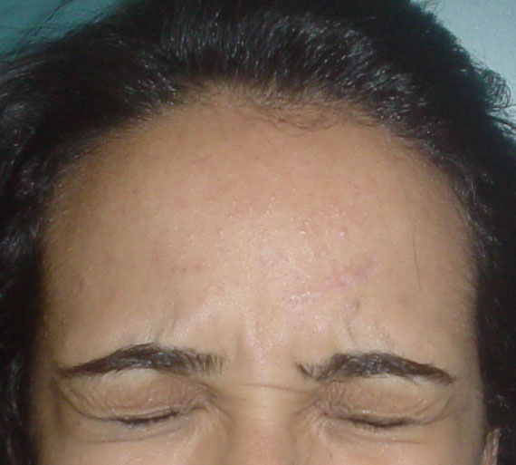 Plastic Surgery Egypt, Aesthetic Surgery, Forehead Scar, Stem Cells, Botox