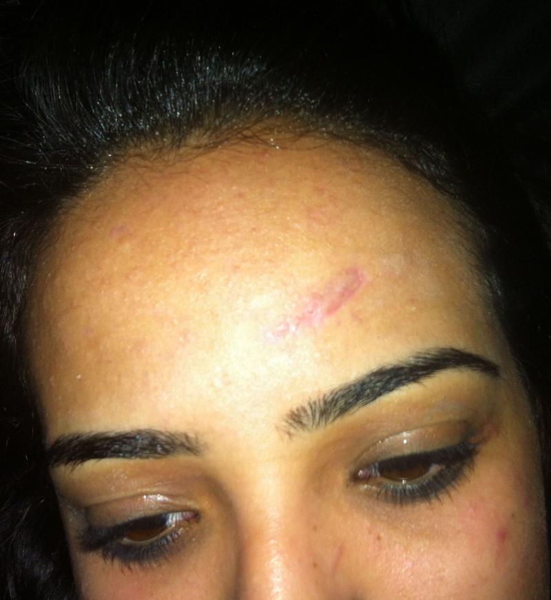 Cosmetic Surgery Egypt, Aesthetic Surgery, Forehead Scar, Stem Cells, Botox