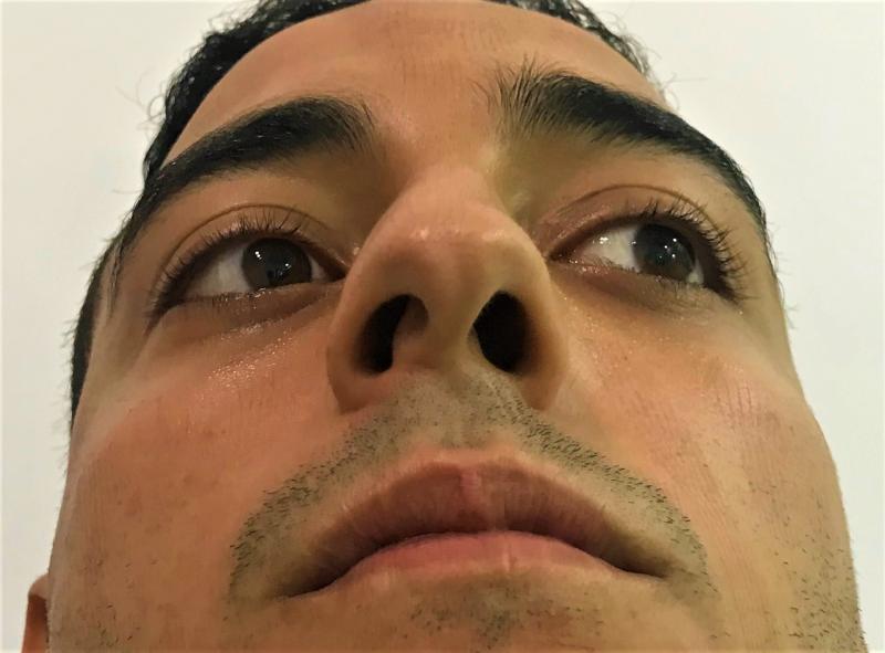 Crooked Nose Job, Rhinoplasty, Nose Deviation, Breathing at Best plastic Surgery