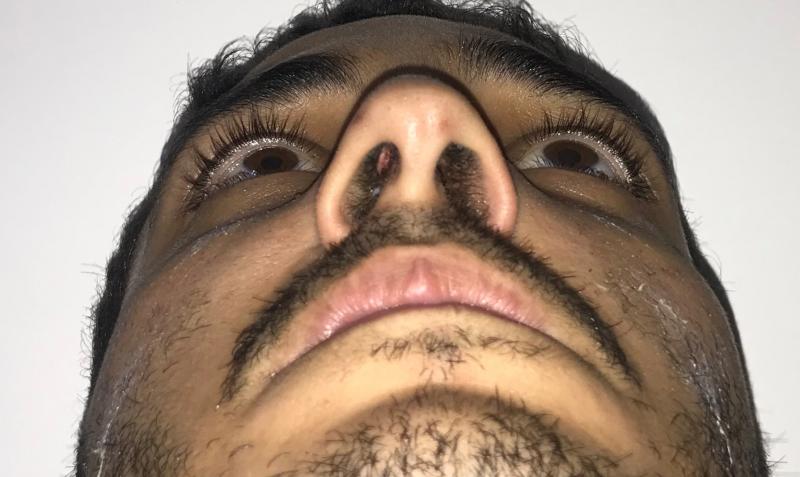 Crooked Nose Job, Rhinoplasty, Nose Deviation, Breathing at Best Cosmetic Surger