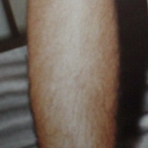Cosmetic surgery in Egypt, Laser Tattoo Removal, Plastic Surgery in Egypt