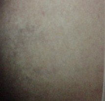 Plastic Surgery in Egypt, Tattoo Removal, Laser, Cosmetic Surgery in Egypt