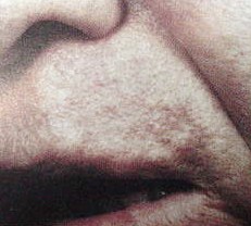 Fractional Laser Cairo Cosmetic plastic surgery  scar resurfacing