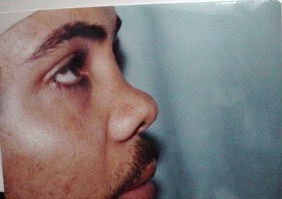 Nose job Egypt Plastic Surgery Saddle nose cartilage dorsum hump tip boxy