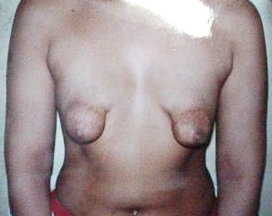 Plastic Surgery in Egypt, Breast Surgery, Breast Deformity, Breast Augmentation,