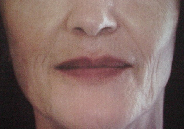 Lip Filler, Lip Enhancement, Dimple Creation, juvederm, Best Cosmetic Surgery