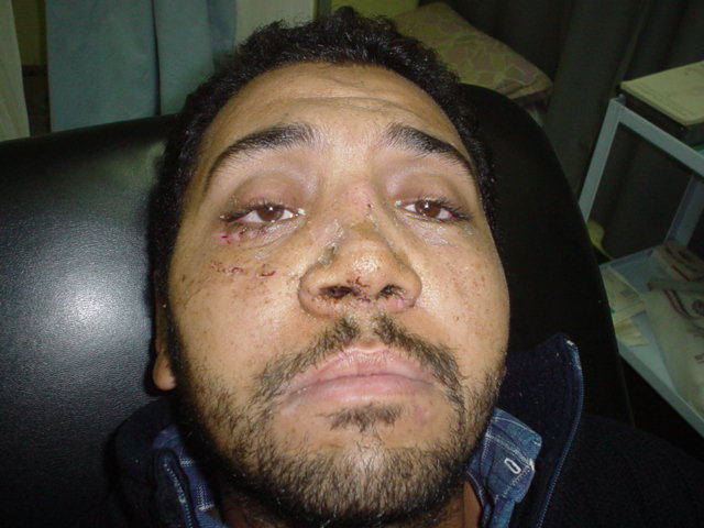 Cosmetic Surgery Egypt,Plastic Surgery,face lift,fracture,zygoma,Cairo,trauma