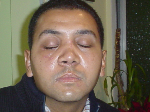 Plastic Surgery Egypt,Cosmetic,maxilla,fracture,aesthetic surgery,Cairo,trauma