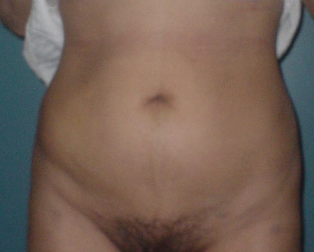 Liposuction,Laser lipo,Smart liposuction,egypt,Cairo,abdominal liposuction,