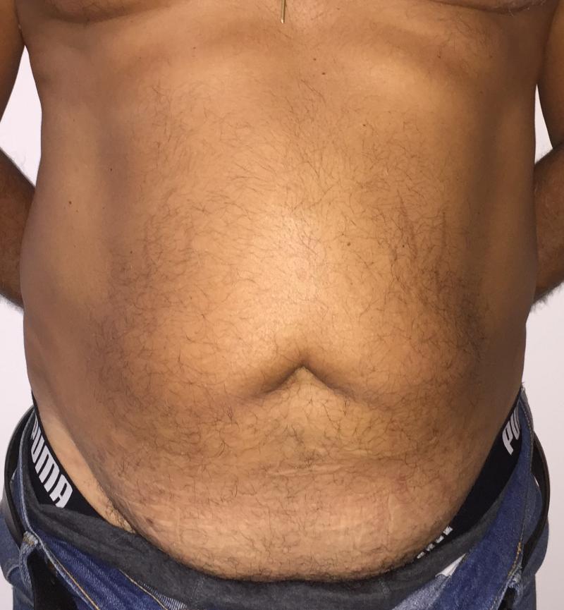 Laser Liposuction, 4D Lipocontouring, Love Handle Liposuction, Cosmetic Surgery
