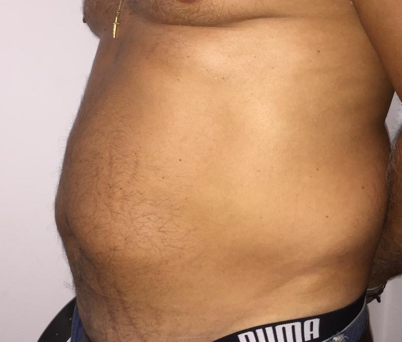 Laser Liposuction, 4D Lipocontouring, Love Handle Liposuction, Plastic Surgery