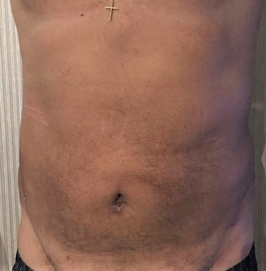Vaser Liposuction, 4D Lipocontouring, Love Handle Liposuction, Cosmetic Surgery