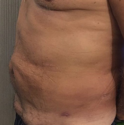 Vaser Liposuction, 4D Lipocontouring, Love Handle Liposuction, Plastic Surgery