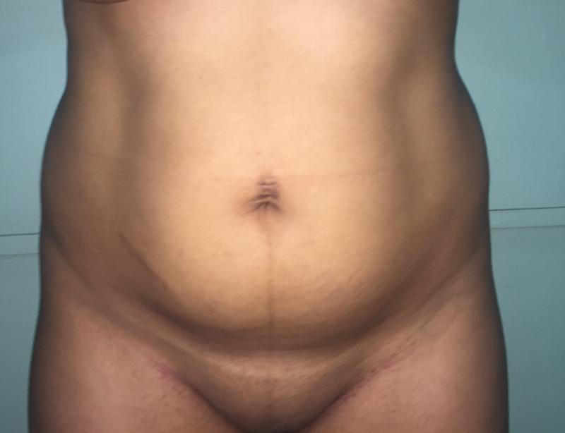 شفط الدهون بالليزر شفط الدهون بالفيزر تنسيق القوام جراحة التجميل مصر smart lipo
