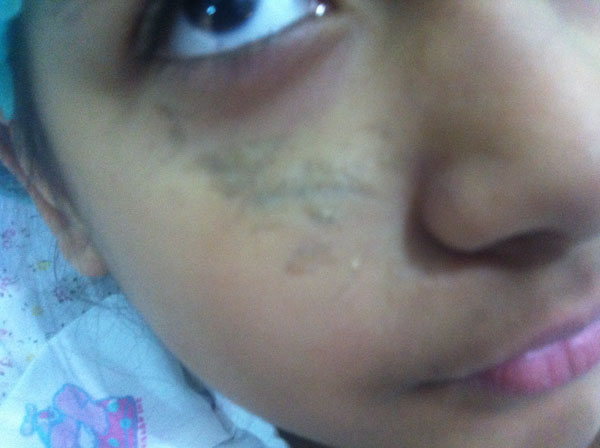 Scar Egypt, Stem Cells Egypt, Face Lift Egypt, Best Plastic Surgery Egypt