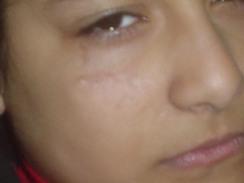 Scar Egypt, Stem Cells Egypt, Face Lift Egypt, Best Cosmetic Surgery Egypt