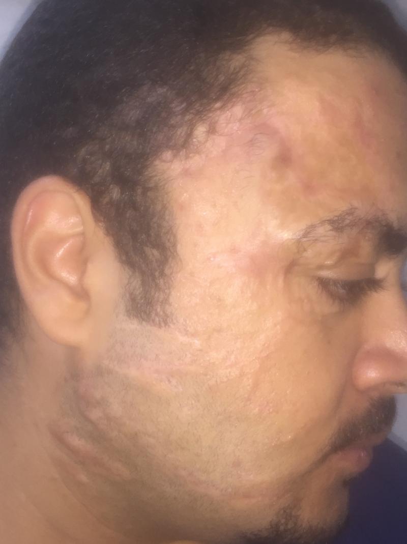 Face Surgery, Face lift, Face fractures, Plastic Surgery Face, Mandible fractur