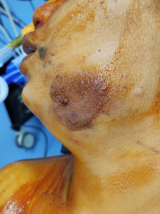 Face Lift and Neck Flap at Best Plastic Surgery in Egypt for Face Face hemangiom