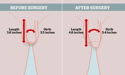 Penile Enlargement Surgery, Fat Grafting, Fat Injection, penile Lengthening