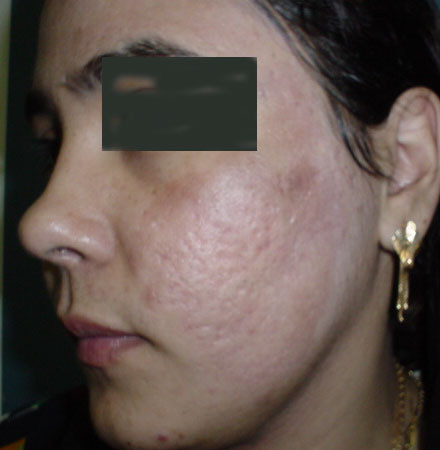 Acne scar laser Egypt cosmetic surgery Fractional Erbium CO2