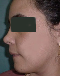 Skin rejuvenation plastic surgery egypt Laser IPL pitting acne scarring Fraxel