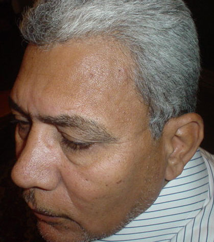 Cosmetic Surgery Egypt, Face scars, Stem Cells, fat Injection, Fat Grafting