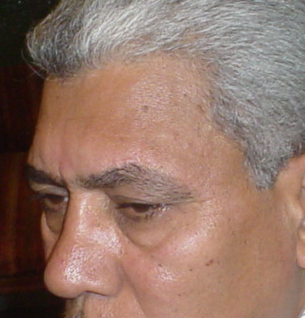 Plastic Surgery Egypt, Face Scars, Stem Cells, fat Injection, Fat Grafting