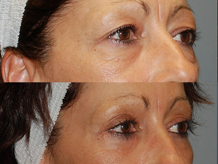 Brow Lift, Forehead Lift, Forehead Wrinkles, Face Lift, Endotyne