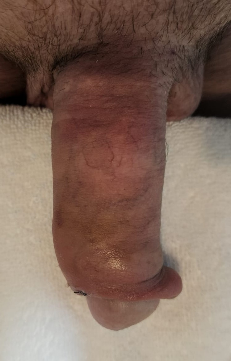 Penile Enlargement by Fat Injection in the Penis at Best Plastic Surgery Egypt