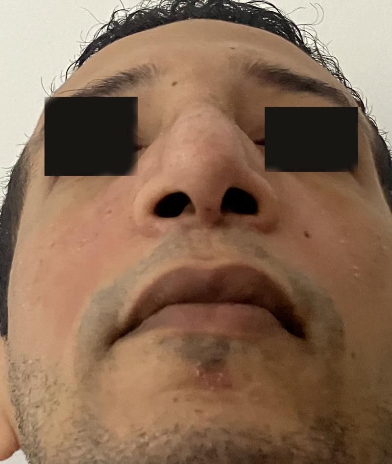 Nose Hump and Overhanging Boxy tip for Rhinoplasty at Best Cosmetic Surgery