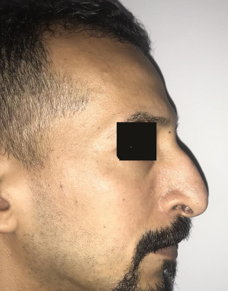 Big Humped nose and Overhanging Boxy tip for Rhinoplasty at Best Plastic Surgery