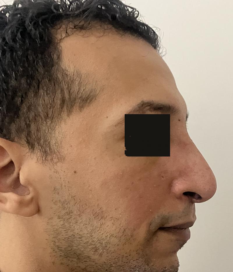 Big Humped nose and Overhanging Boxy tip for Rhinoplasty at Best Cosmetic Surger