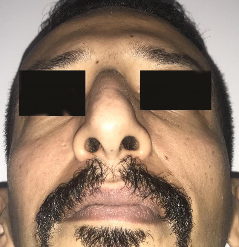 Nose Hump and Overhanging Boxy tip for Rhinoplasty at Best Plastic Surgery