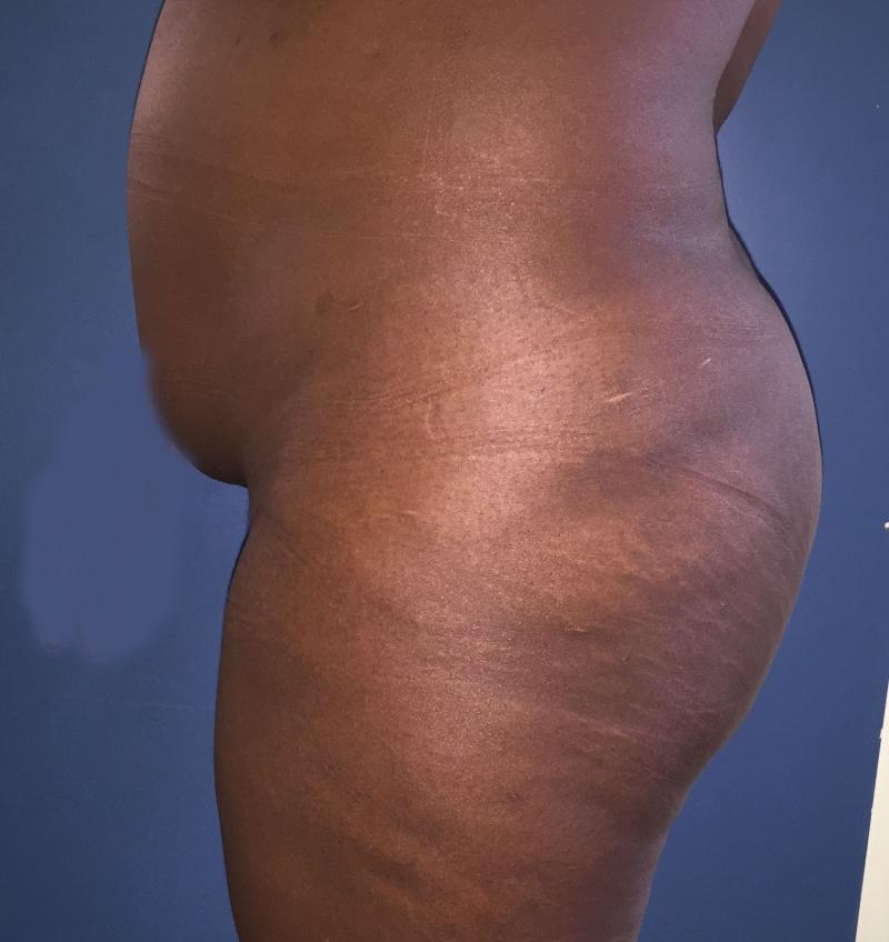 Buttock Implants, Buttock Augmentation, Best Cosmetic Surgery, Butt Enlargement