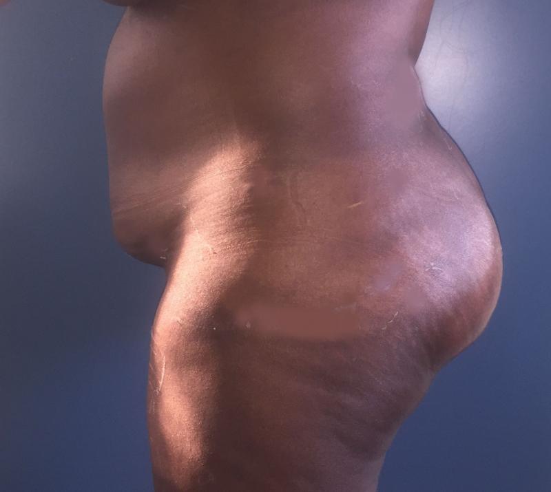 Buttock Implants, Buttock Augmentation, Best Plastic Surgery, Butt Enlargement