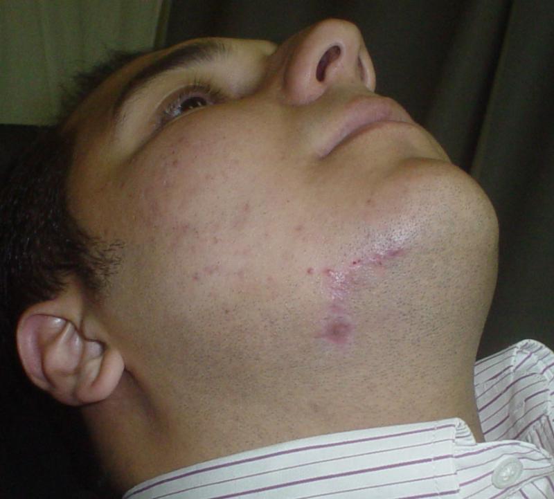 Plastic surgery egypt cosmetic wound scar laser filler deformity restylane