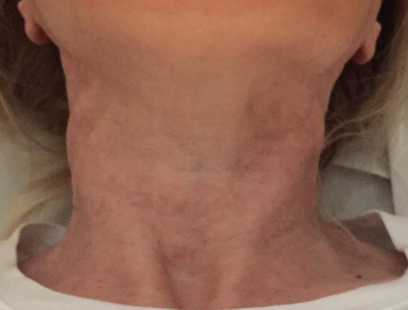 Neck Laser, Neck Fractional Laser, Neck Wrikles, Best Plastic Surgeon, Neck Lift