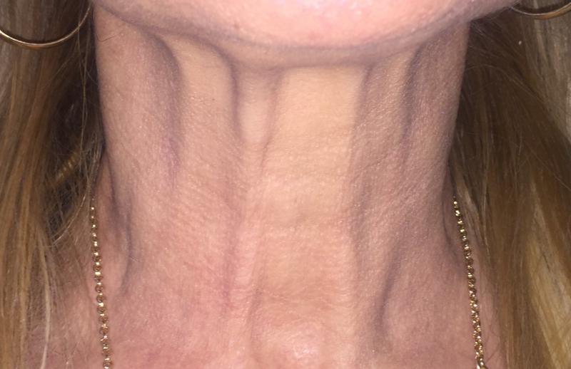 Neck Laser, Neck Fractional Laser, Neck Wrikles, Best Cosmetic Surgeon, Neck Lif