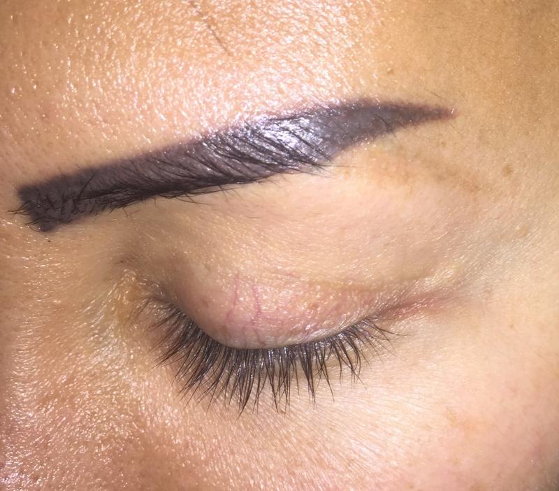 Best Cosmetic Surgery Egypt, Tatoo removal, Eyebrow tatoo, Scar removal, Laser