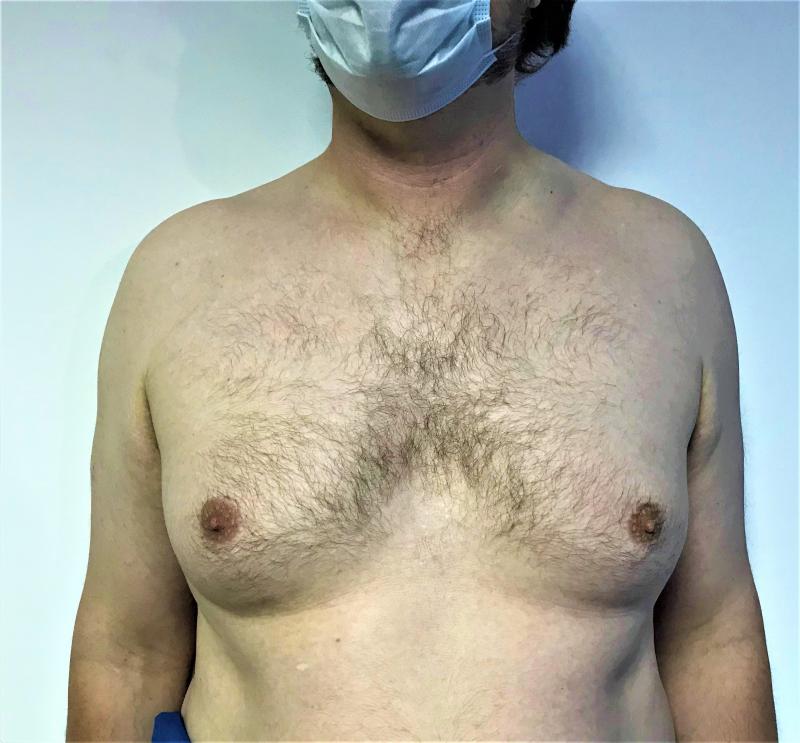 Male Breast Reduction, Gynecomastia Reduct, Laser 4D High Definition Liposuction