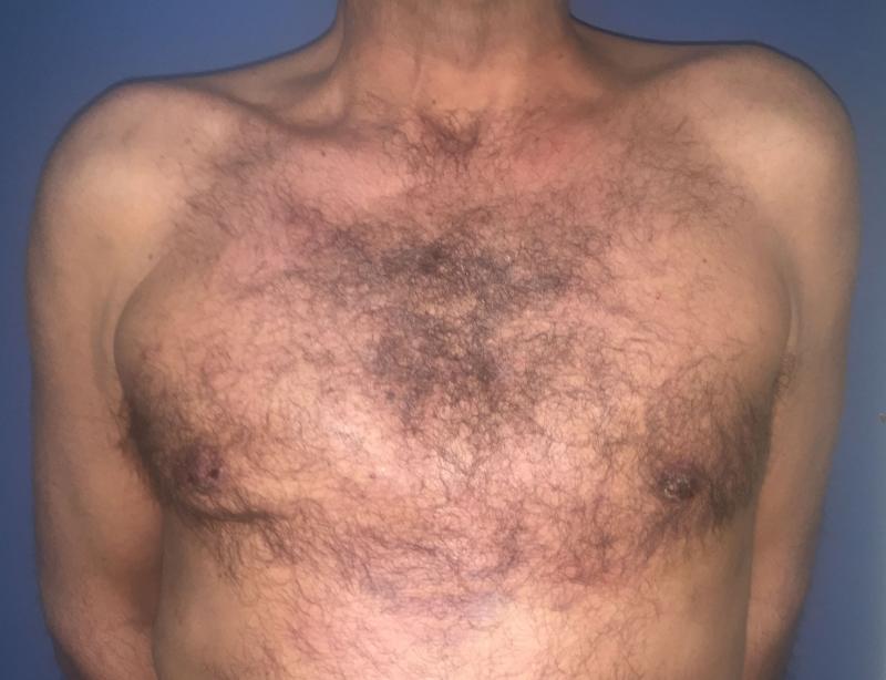 Gynecomastia Egypt, Male Breast Reduction Egypt, Breast Lift, Plastic Surgery
