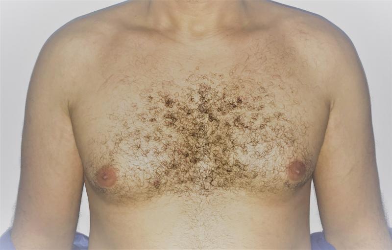 Gynecomastia, Male Breast Reduction, Gland Disc Breast, Best Cosmetic Surgery