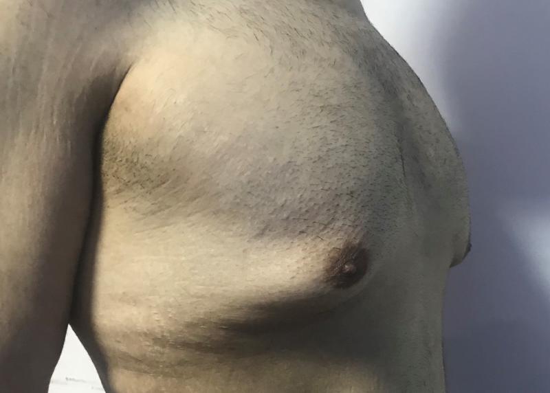 Gynecomastia after sleeve gastrectomy and nipple at Best Cosmetic Surgery Egypt