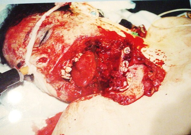 Plastic Surgery Egypt,Cosmetic,face lift,fracture,mandible,breast,Cairo,trauma