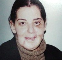 Cosmetic Surgery Egypt,Plastic Surgery,face lift,fracture,mandible,Cairo,trauma