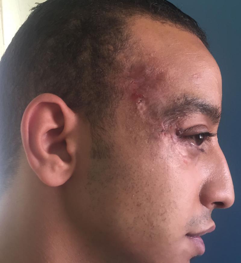 Best Aesthetic Surgery Egypt, Scars, Cheek and Face Lift, Stem Cells, Laser Lipo