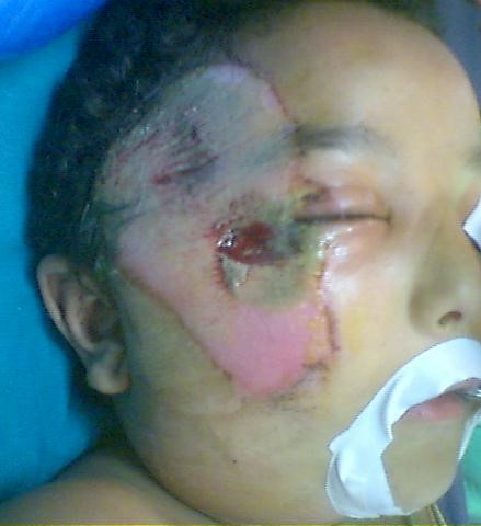 Best Plastic Surgery Egypt, Scars, Cheek and Face Lift, Stem Cells, Laser, 