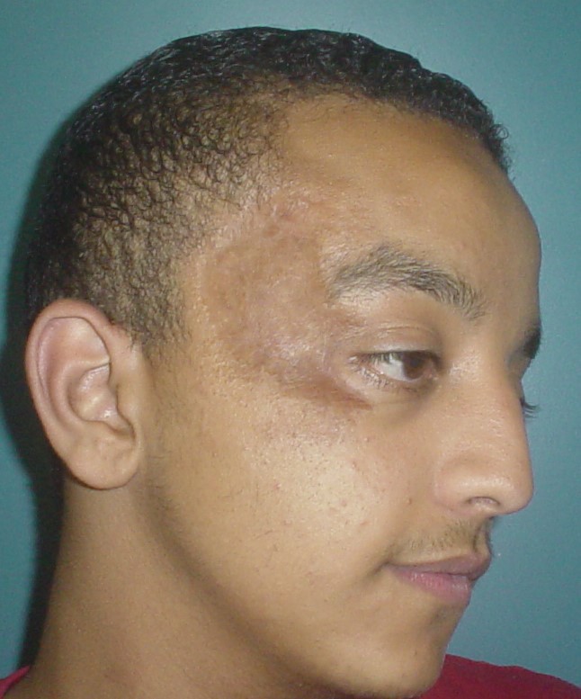 Best Cosmetic Surgery Egypt, Scars, Cheek and Face Lift, Stem Cells, Vaser Lipo,