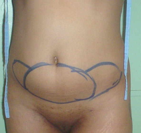 Egypt,Plastric Surgery,Cosmetic Surgery,lipolysis,mesotherapy,liposuction,fat