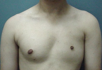 Plastic Surgery Egypt Cairo Pectus Excavatus Gynecomastia breast male reduction 